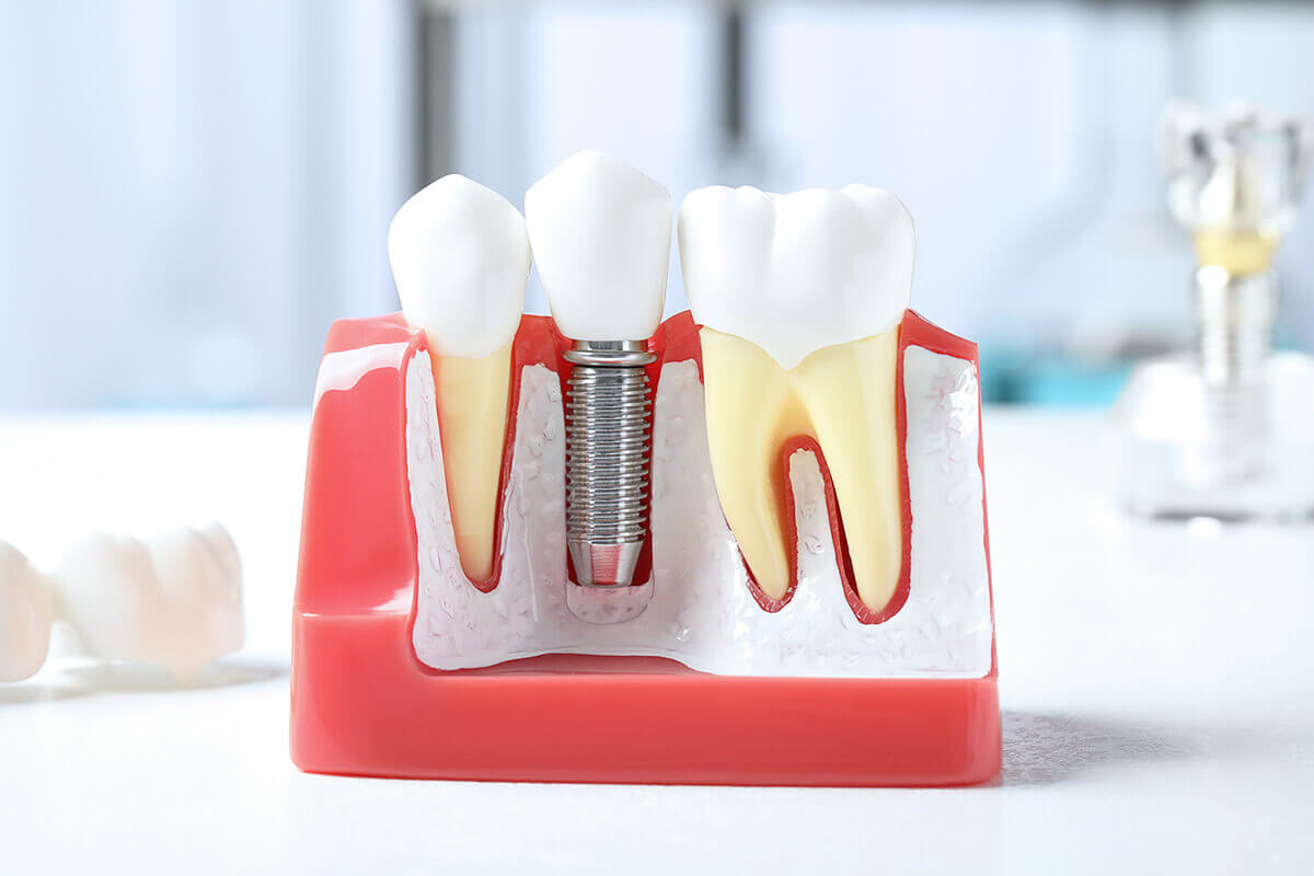 精密なインプラント治療