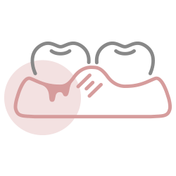 歯ぐきが腫れた・血が出る