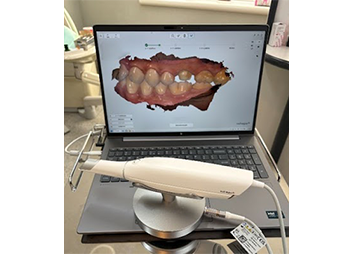 口腔内スキャナー（デジタル印象採得装置｜トリオス）