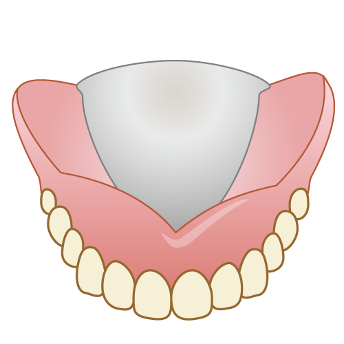 メタルデンチャー